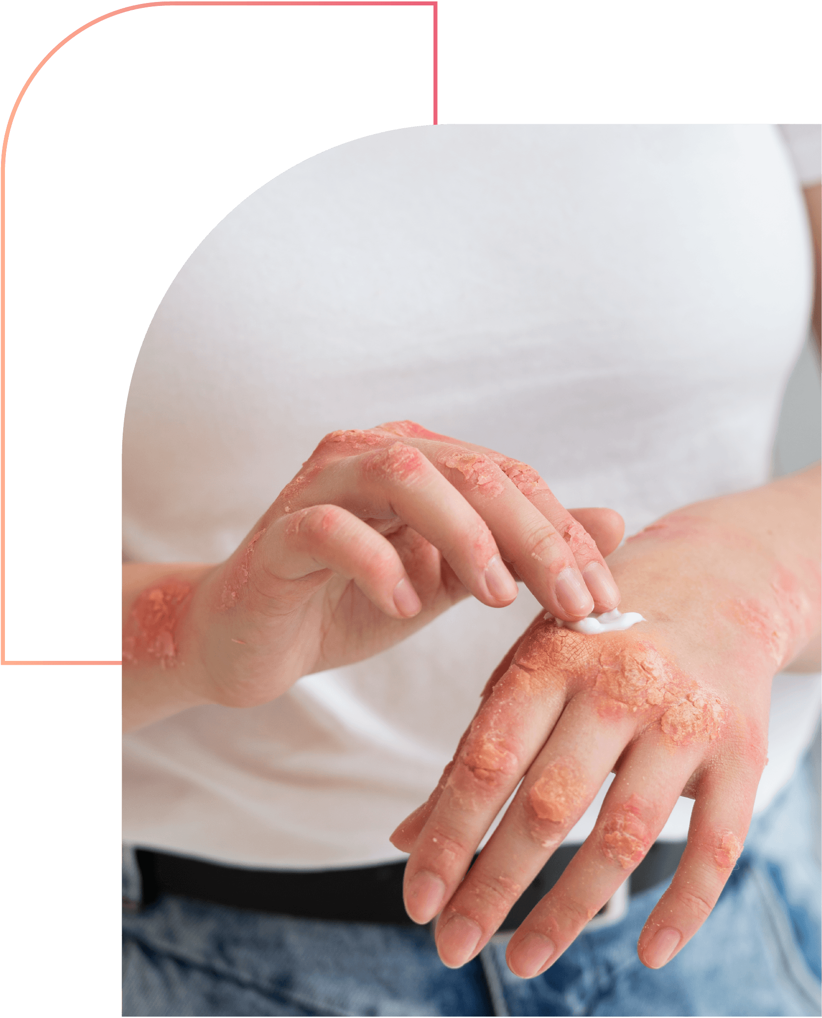 Antifungal Solutions